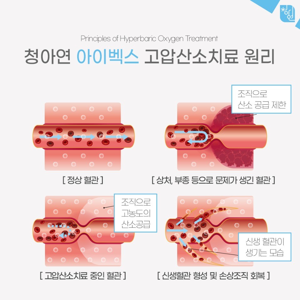 고압산소치료3.jpg